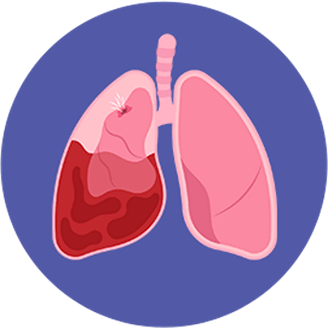 โรคปอดอุดกั้นเรื้อรัง ( COPD )